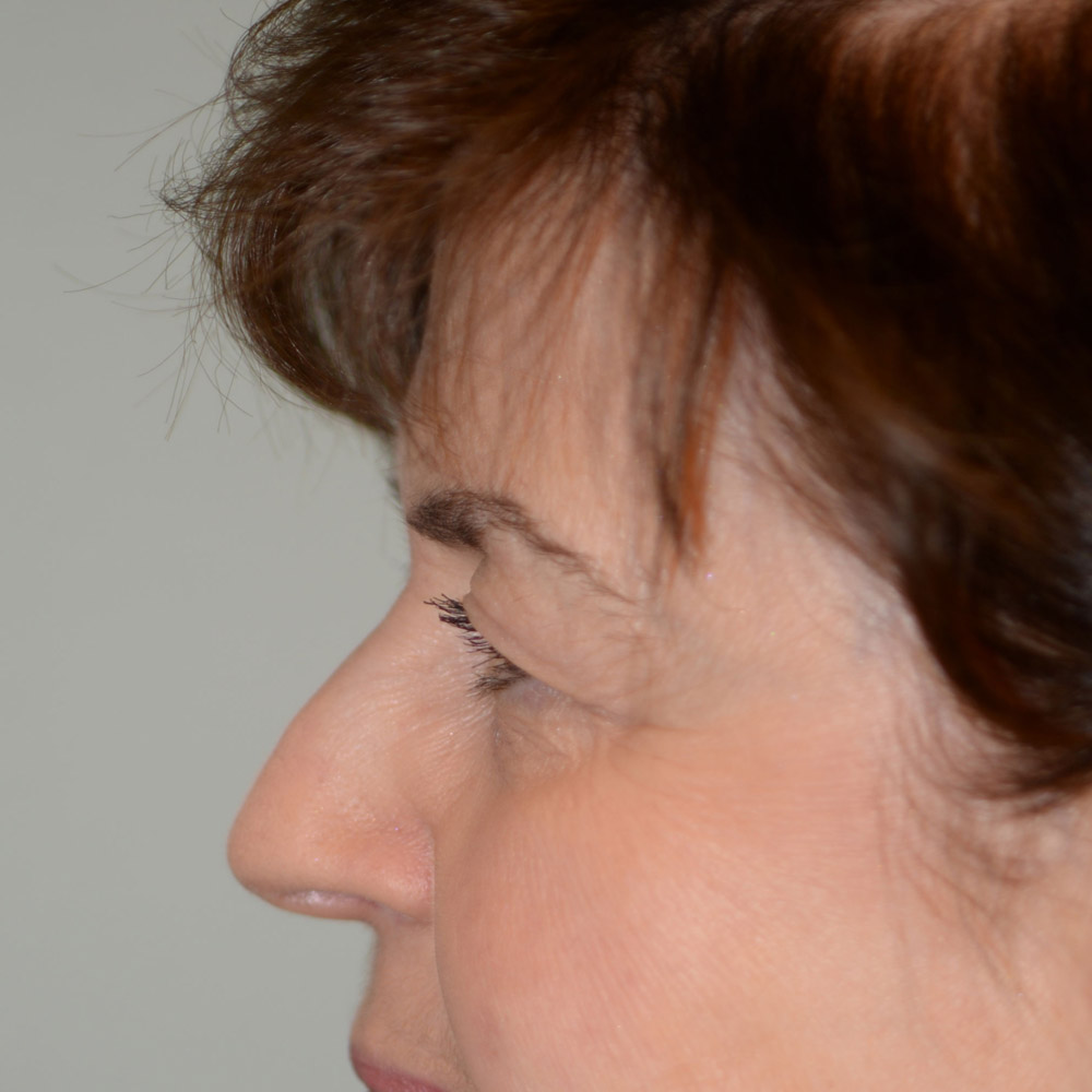 6328 Before Blepharoplasty - Lake Oswego and Portland, Oregon