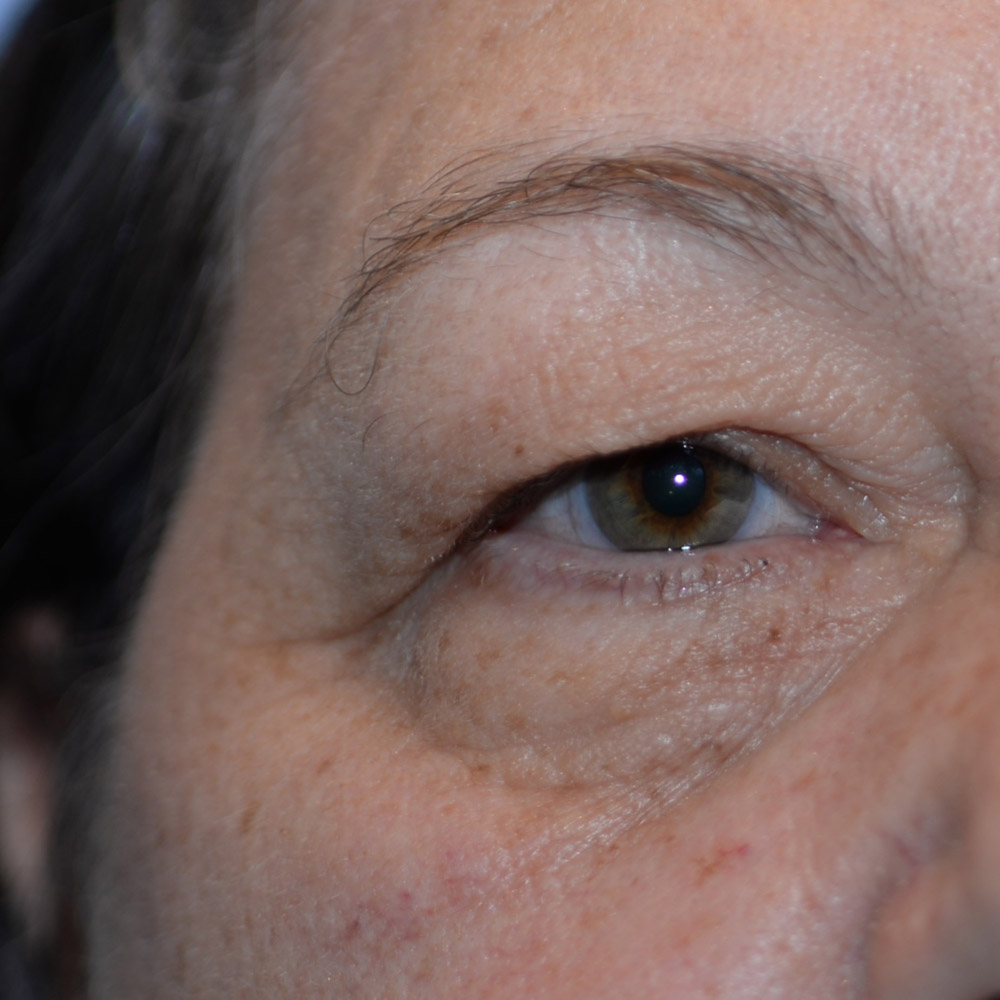 6736 Before Blepharoplasty - Lake Oswego and Portland, Oregon