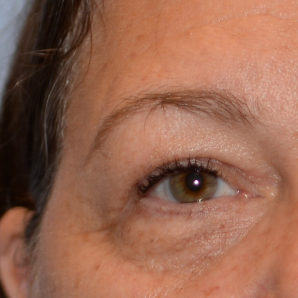 6736 After Blepharoplasty - Lake Oswego and Portland, Oregon