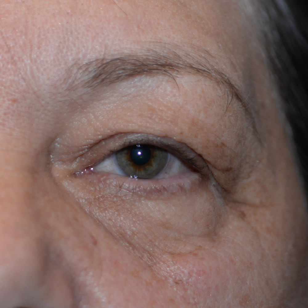6736 Before Blepharoplasty - Lake Oswego and Portland, Oregon