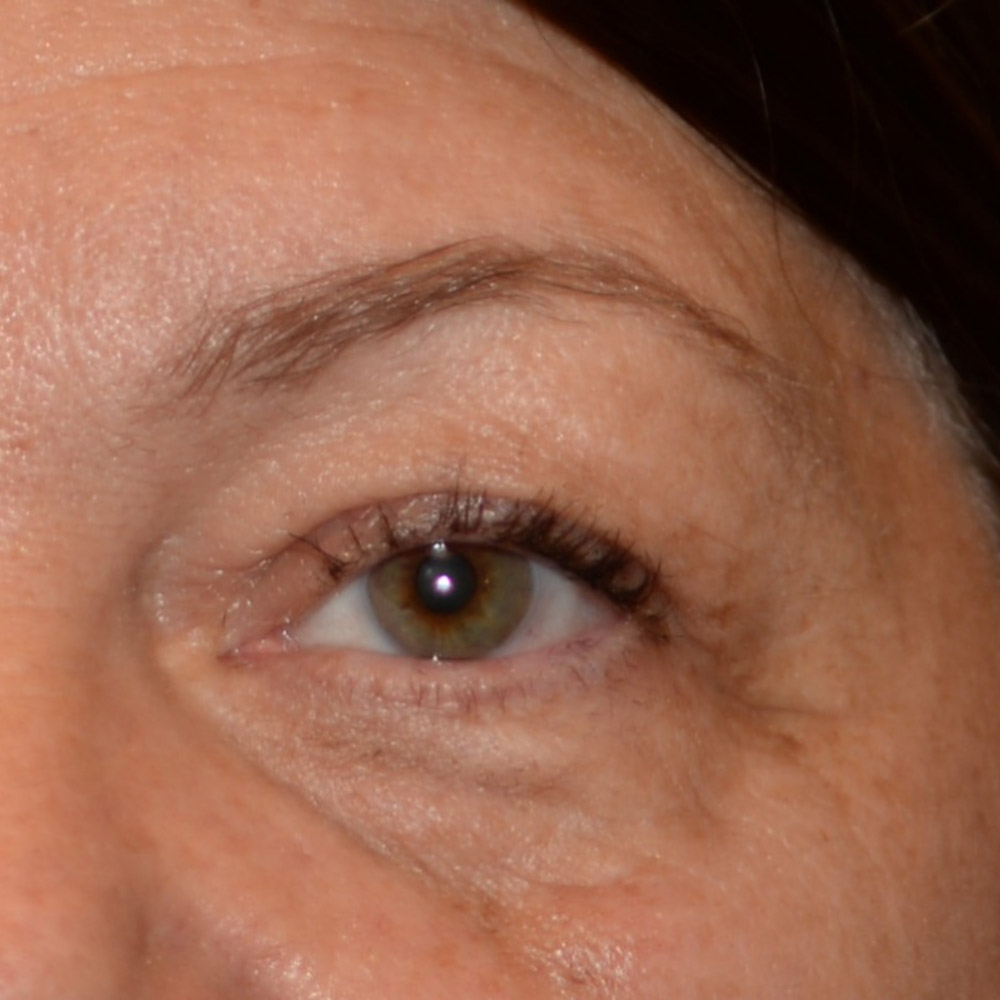 6736 After Blepharoplasty - Lake Oswego and Portland, Oregon