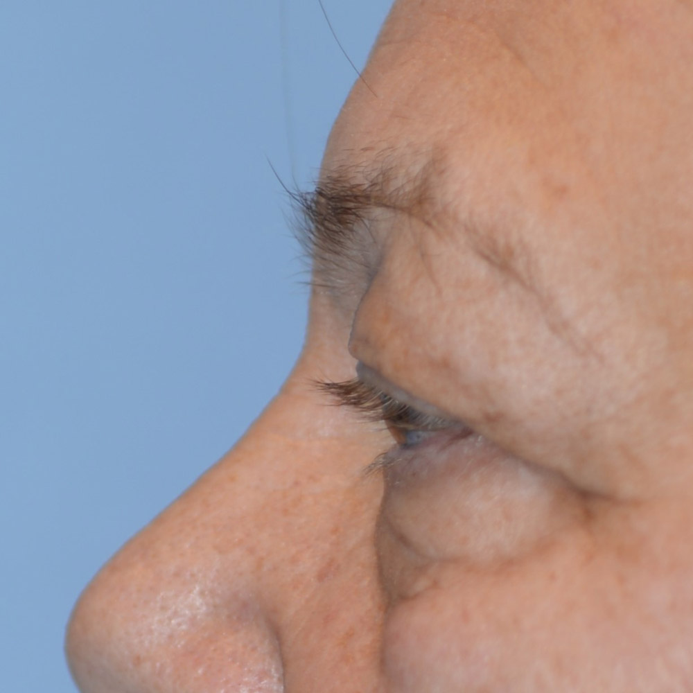 6736 Before Blepharoplasty - Lake Oswego and Portland, Oregon