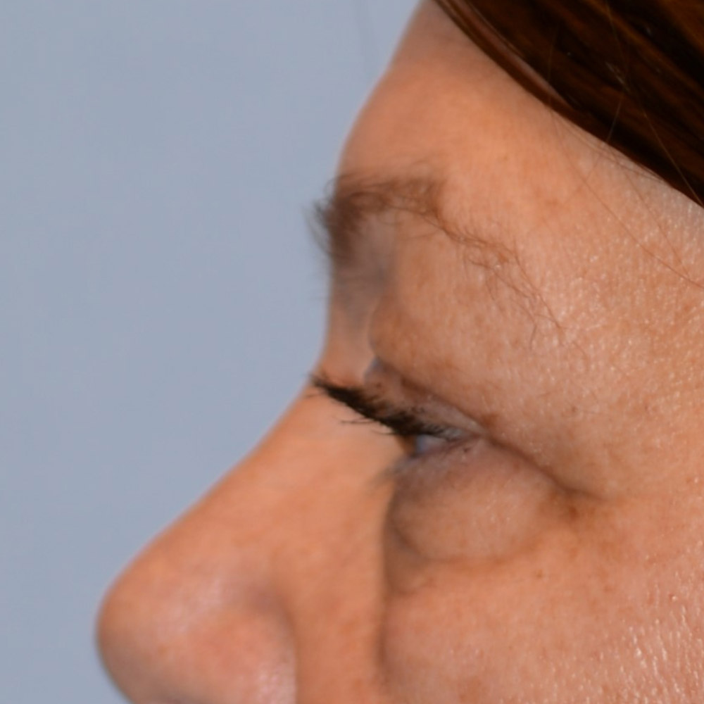 6736 After Blepharoplasty - Lake Oswego and Portland, Oregon