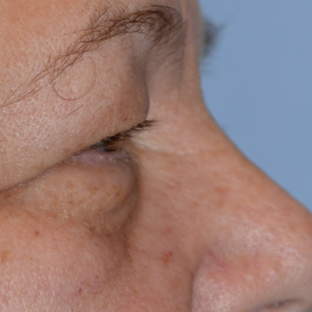 6736 Before Blepharoplasty - Lake Oswego and Portland, Oregon