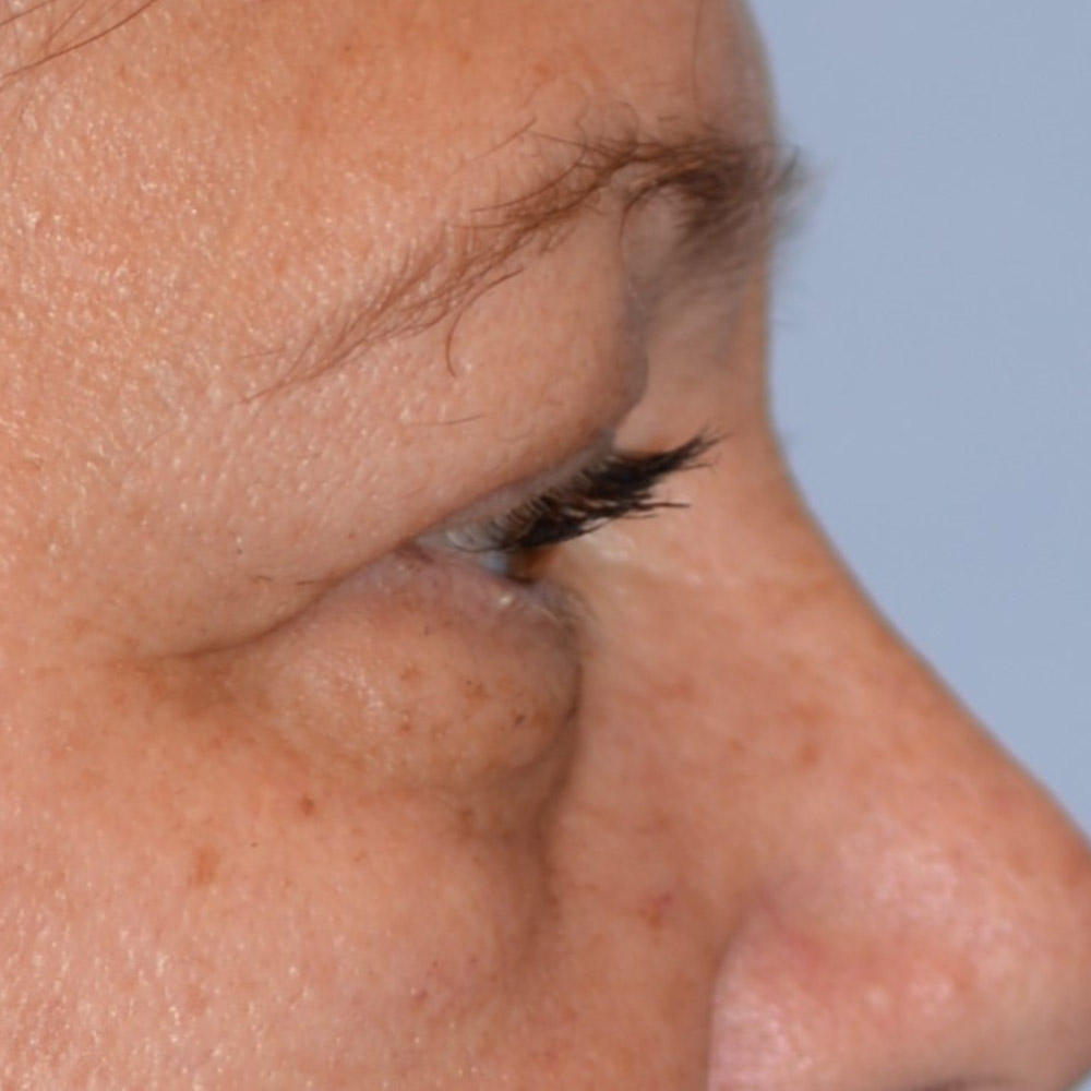 6736 After Blepharoplasty - Lake Oswego and Portland, Oregon