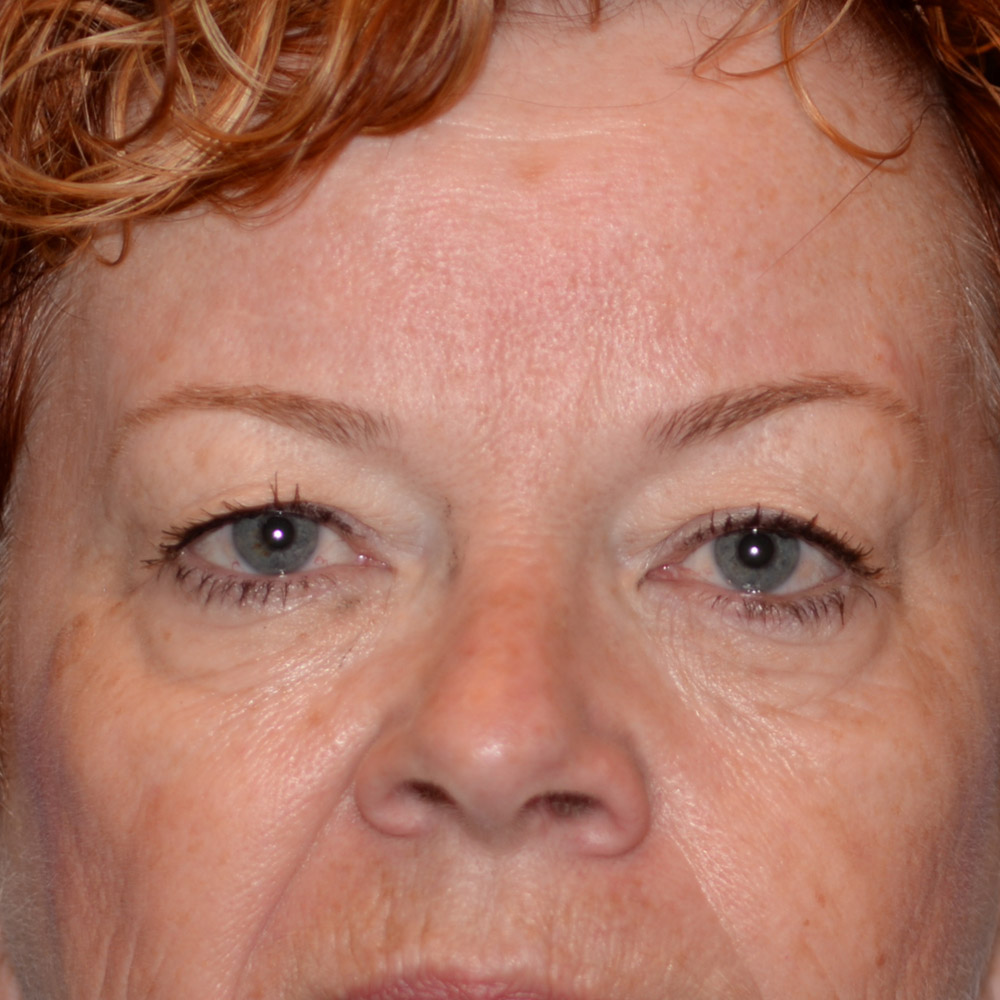 7018 Before Blepharoplasty - Lake Oswego and Portland, Oregon