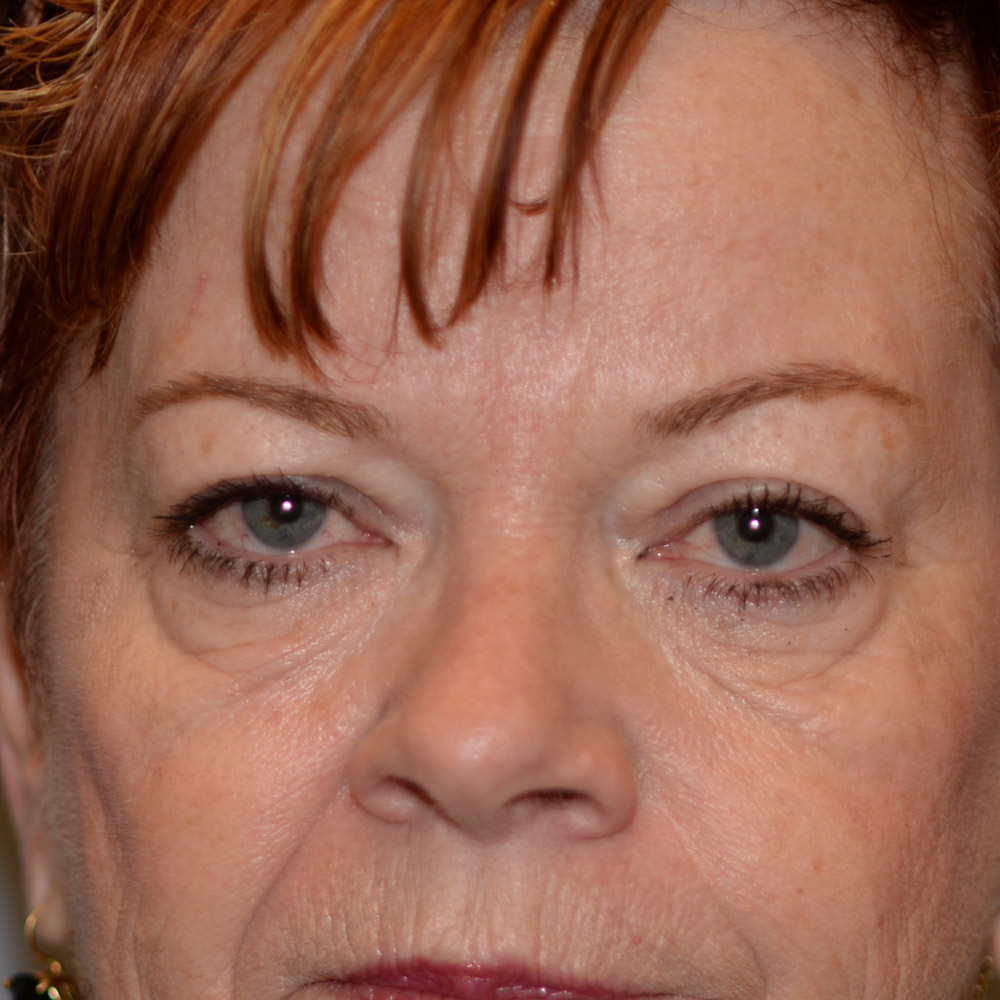 7018 After Blepharoplasty - Lake Oswego and Portland, Oregon