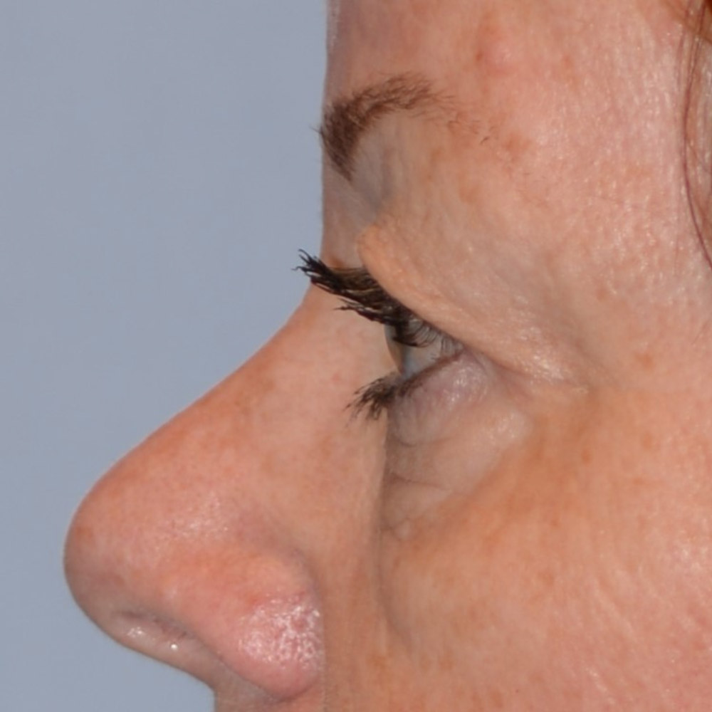 7018 Before Blepharoplasty - Lake Oswego and Portland, Oregon