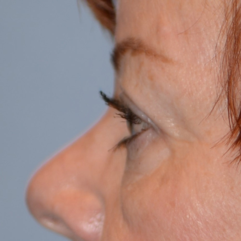 7018 After Blepharoplasty - Lake Oswego and Portland, Oregon