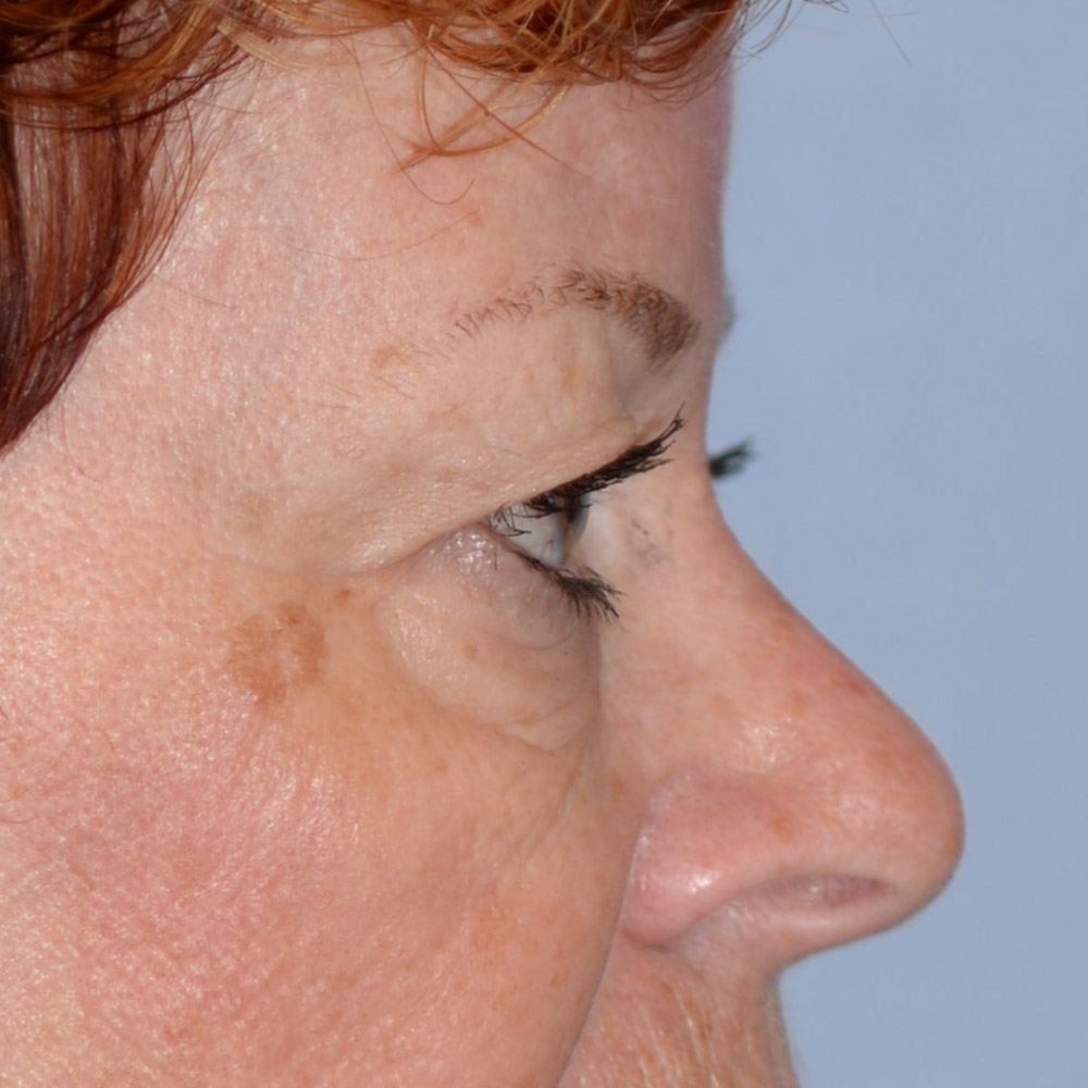 7018 Before Blepharoplasty - Lake Oswego and Portland, Oregon