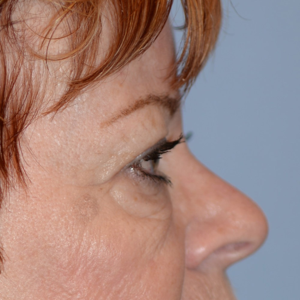 7018 After Blepharoplasty - Lake Oswego and Portland, Oregon