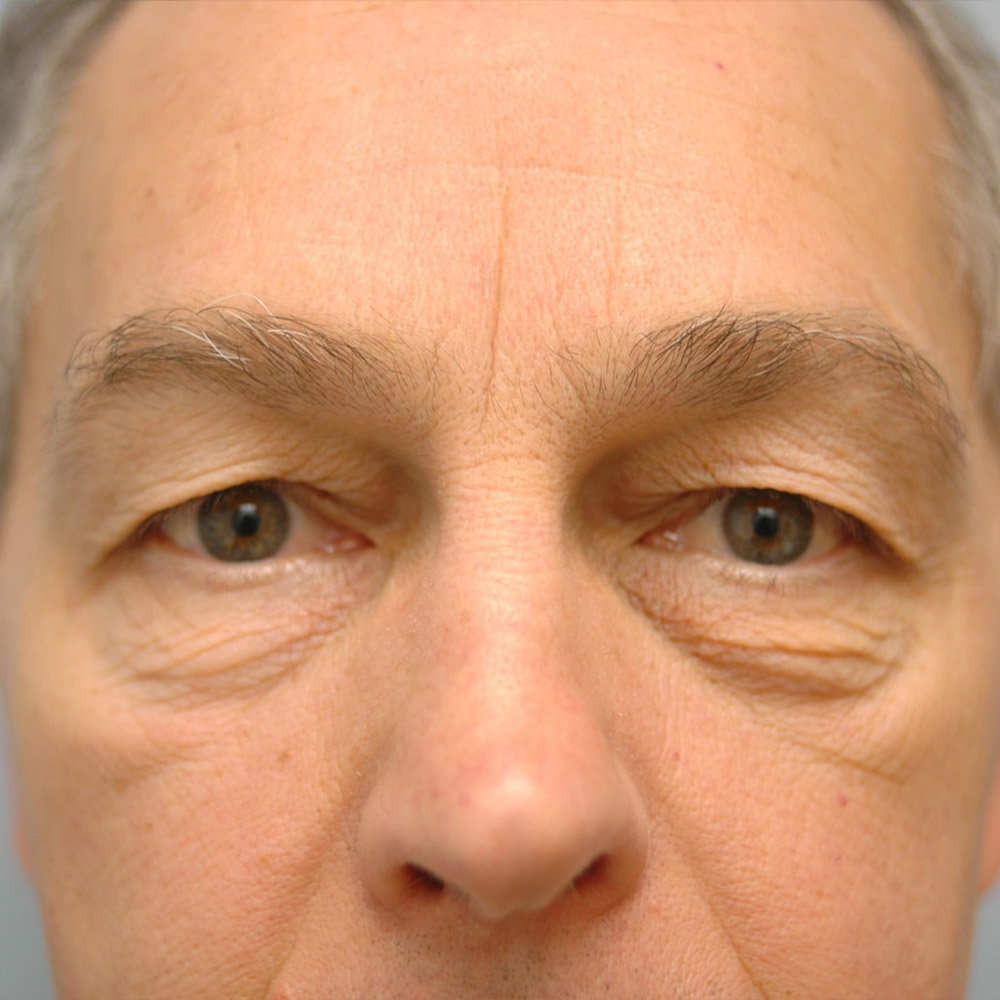8975 Before Blepharoplasty - Lake Oswego and Portland, Oregon