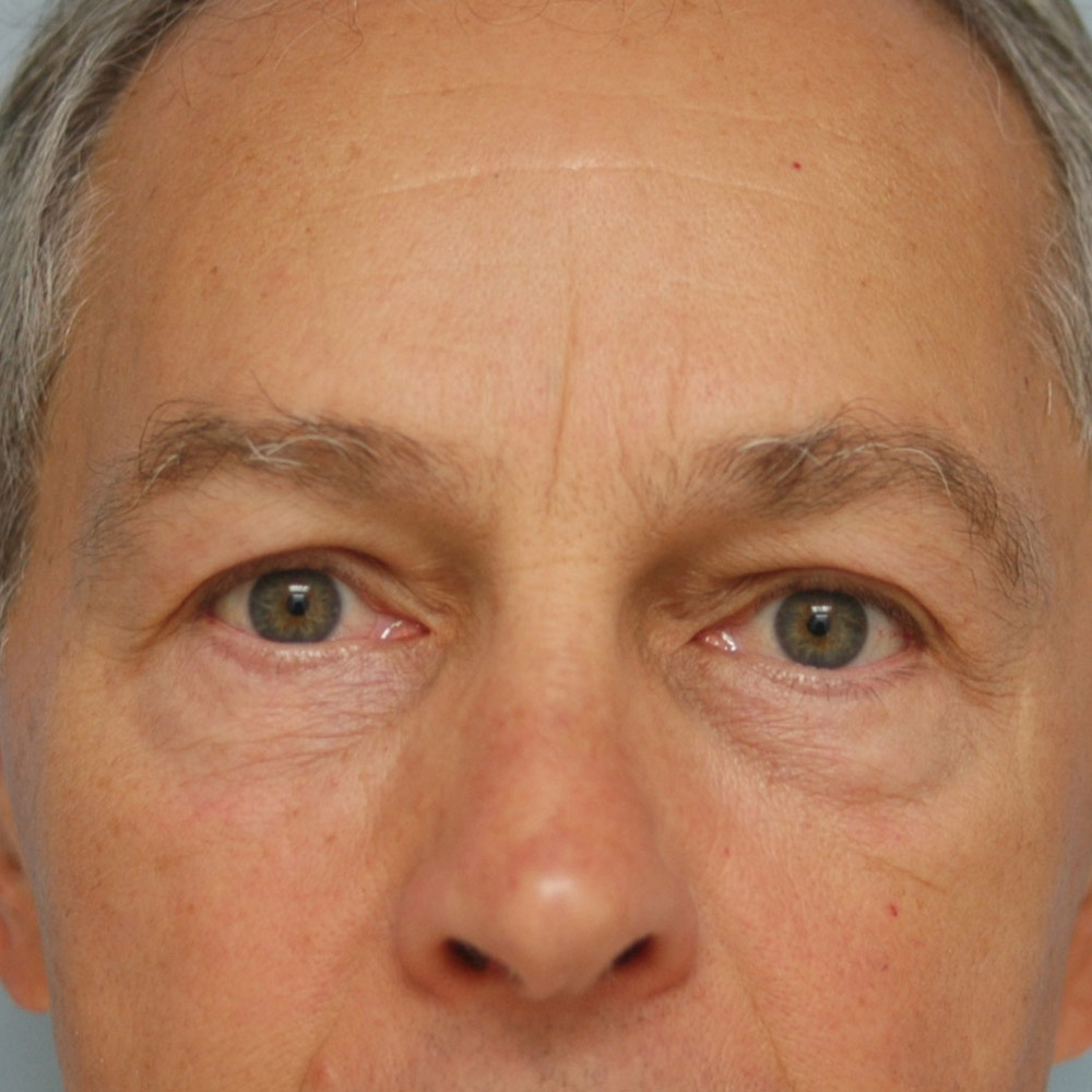 8975 After Blepharoplasty - Lake Oswego and Portland, Oregon