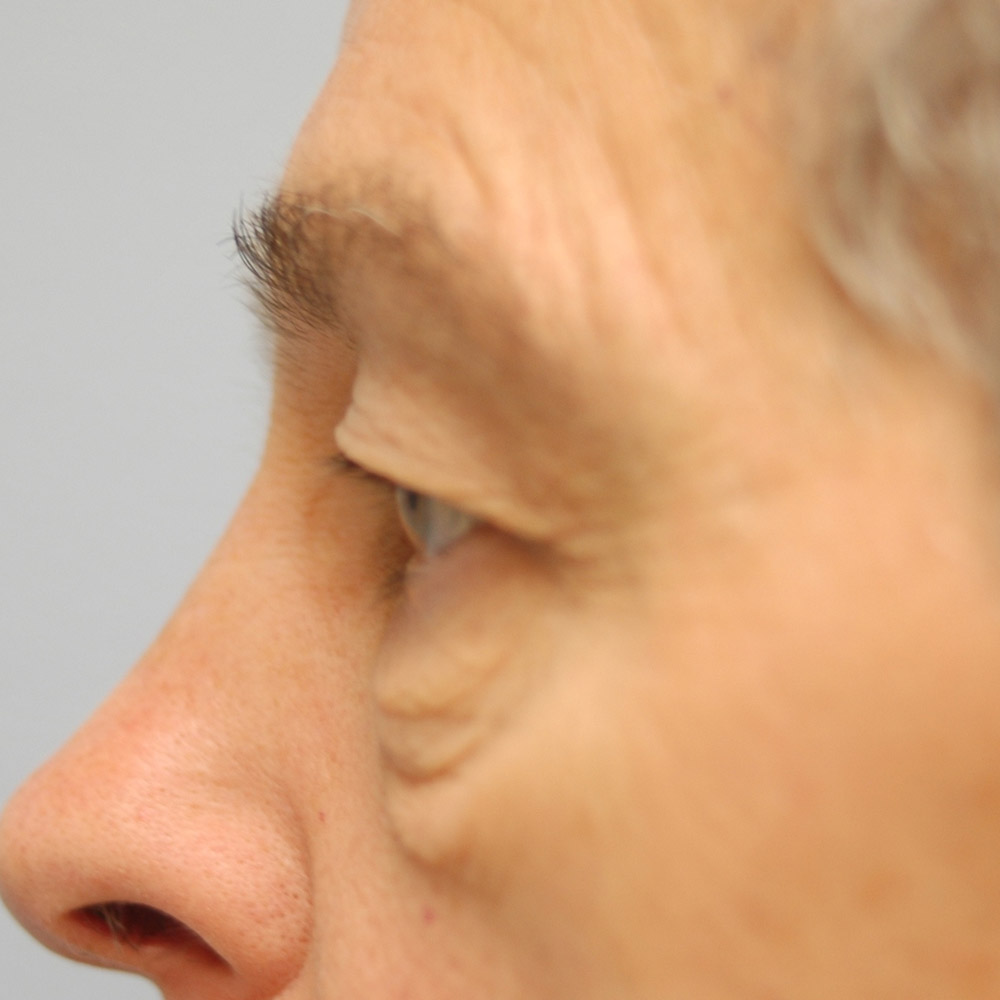 8975 Before Blepharoplasty - Lake Oswego and Portland, Oregon