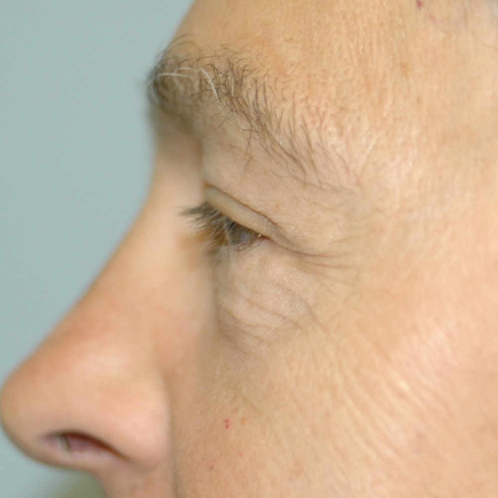 8975 After Blepharoplasty - Lake Oswego and Portland, Oregon