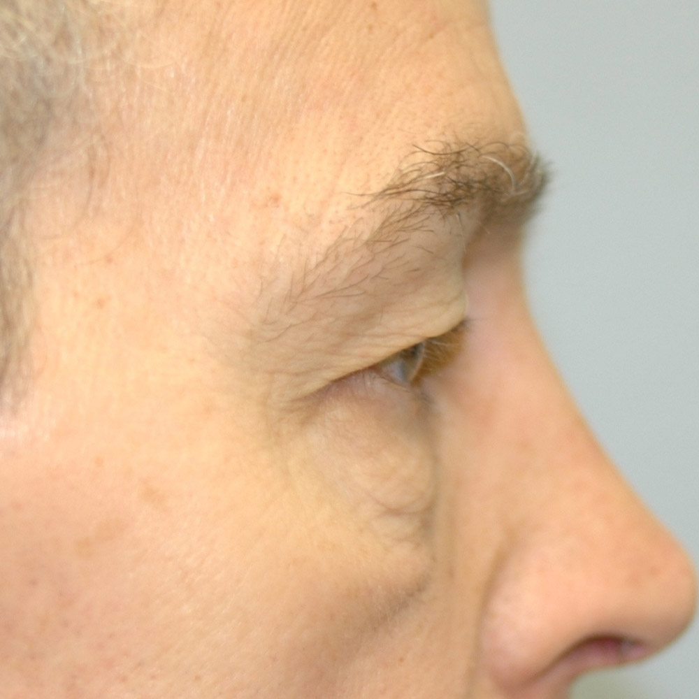 8975 Before Blepharoplasty - Lake Oswego and Portland, Oregon