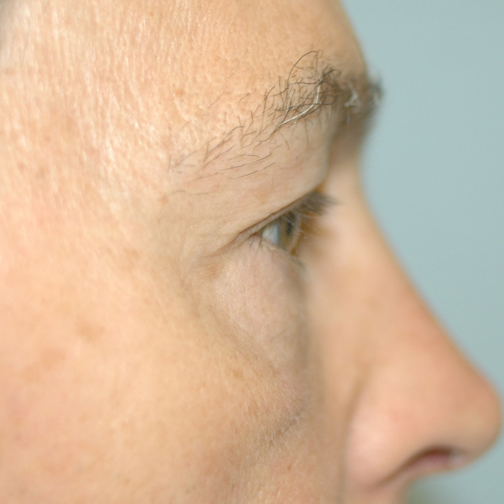 8975 After Blepharoplasty - Lake Oswego and Portland, Oregon