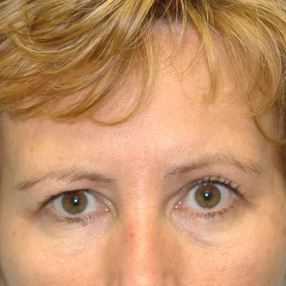 Case--59238 | Before Brow Lift Surgery