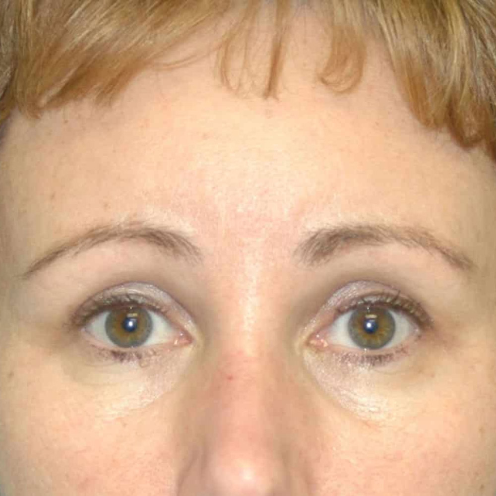 Case--59238 | After Brow Lift Surgery