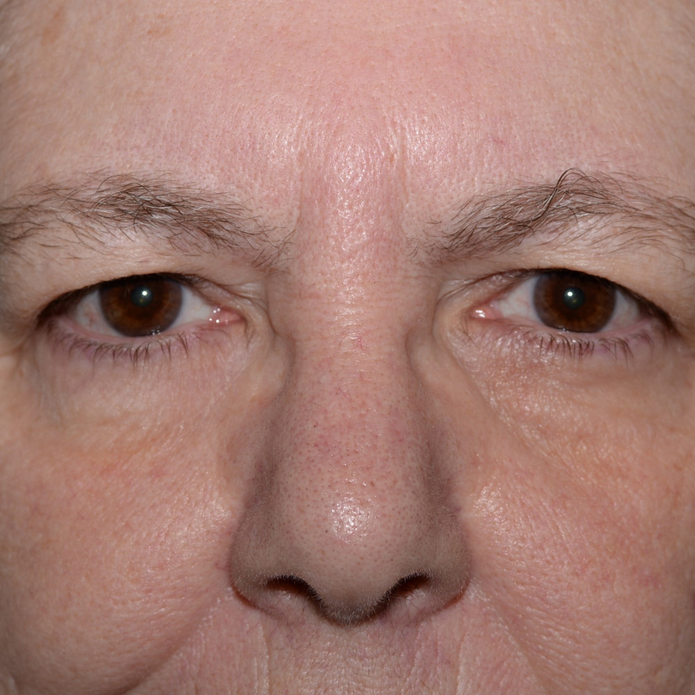 6092 Before Brow Lift Surgery - Lake Oswego and Portland, Oregon