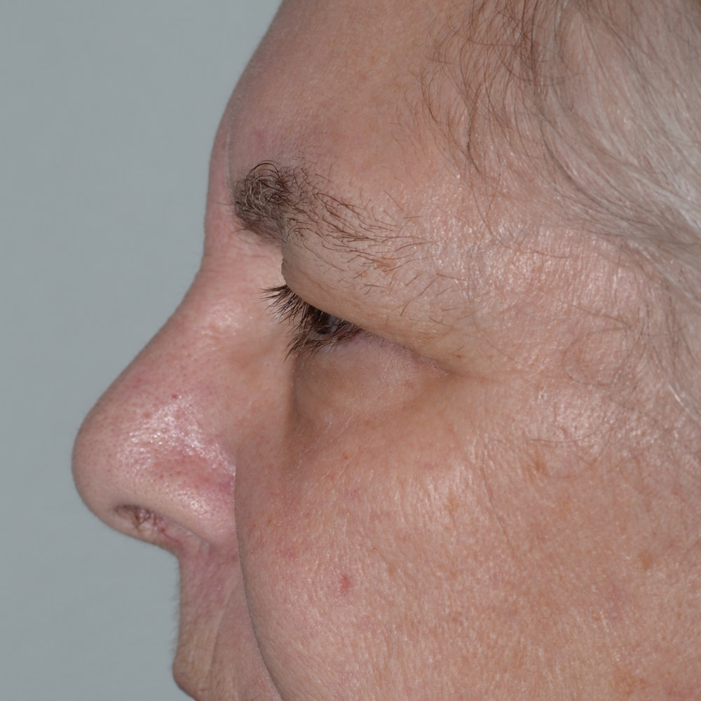 Case--6092 | Before Brow Lift Surgery 2