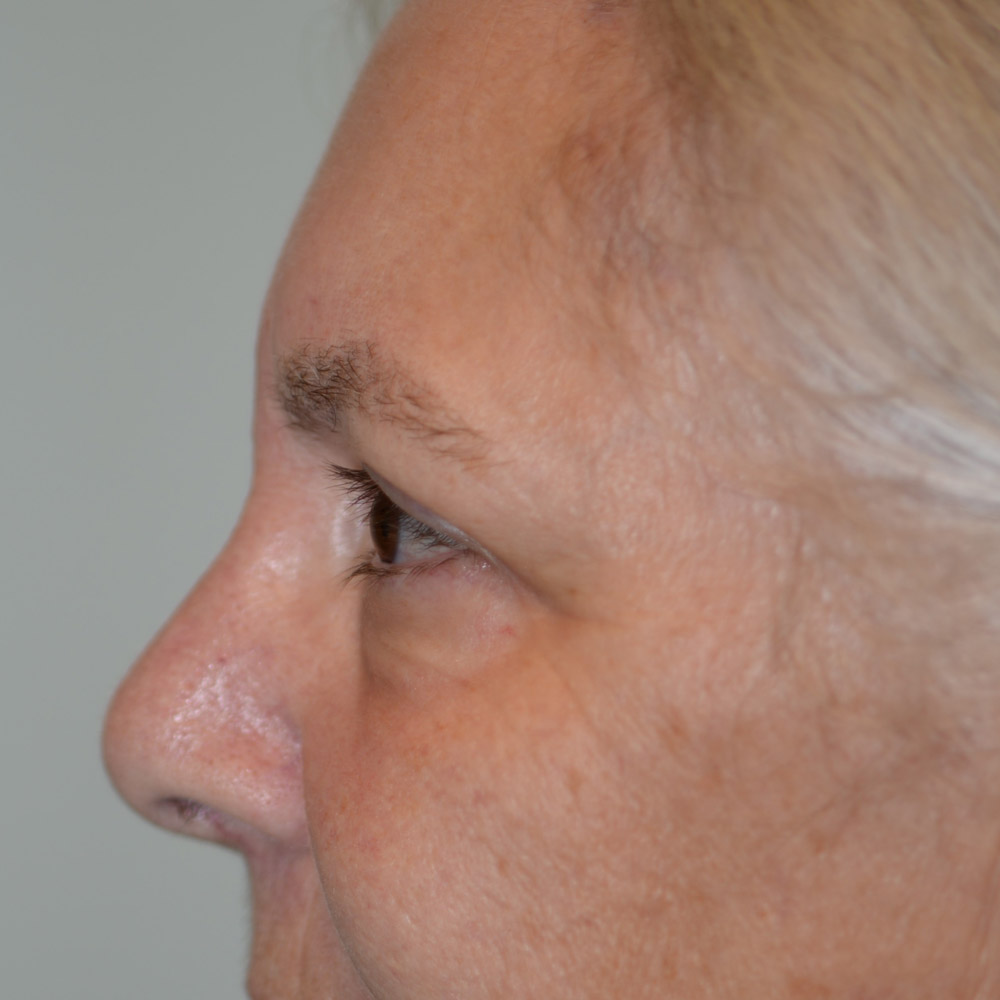 Case--6092 | After Brow Lift Surgery 2