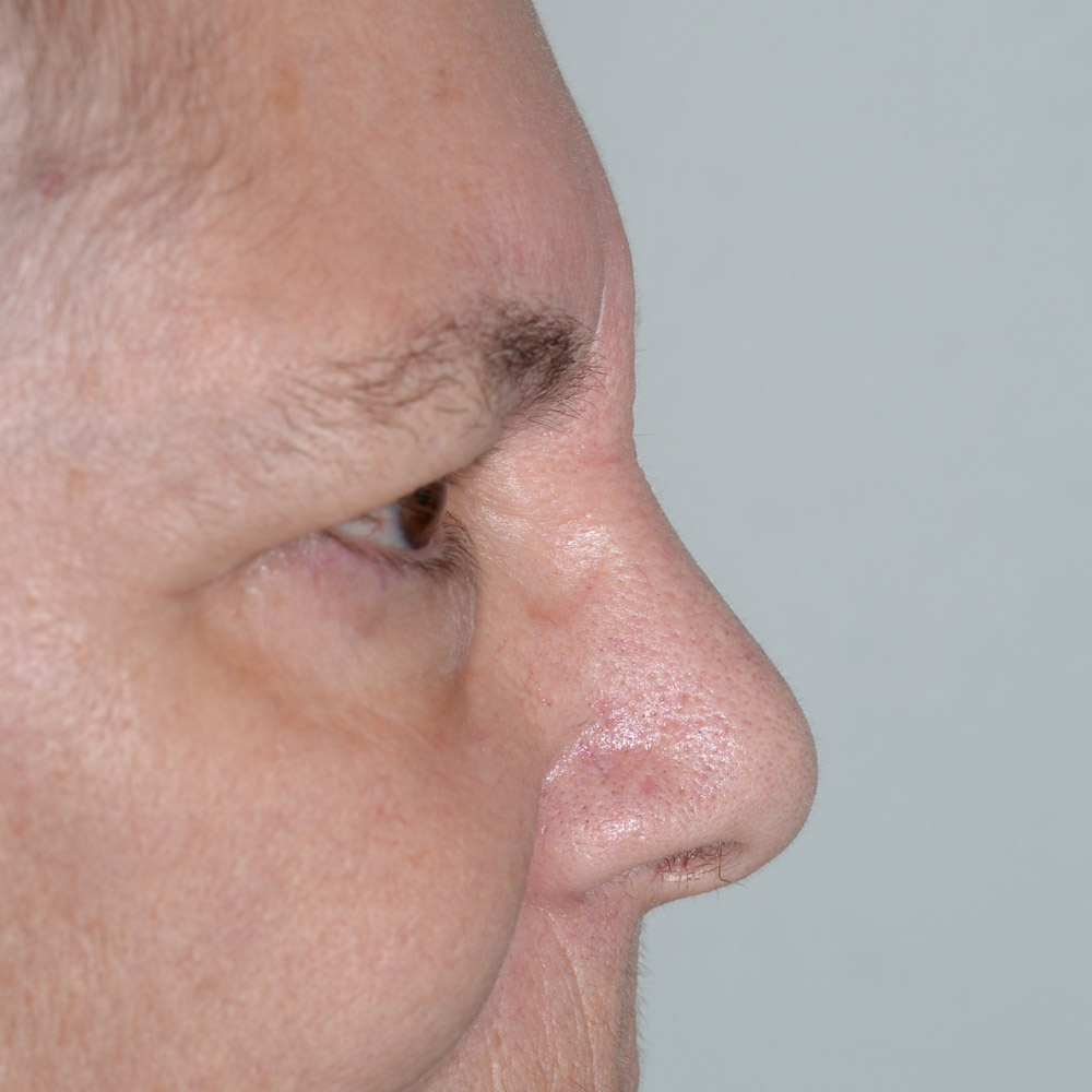 Case--6092 | Before Brow Lift Surgery 3