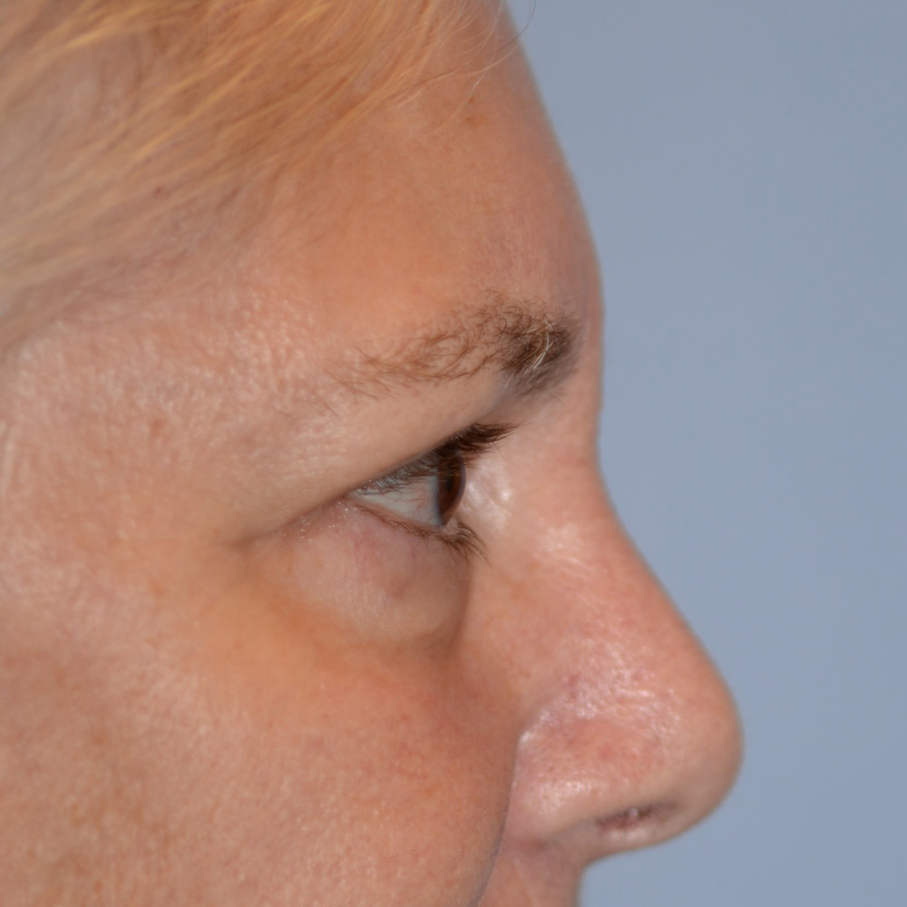 Case--6092 | After Brow Lift Surgery 3
