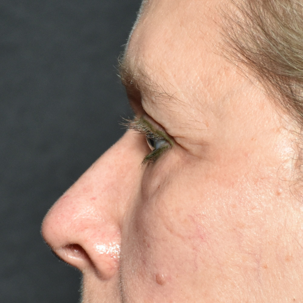 Case--7435 | Before Brow Lift Surgery 2