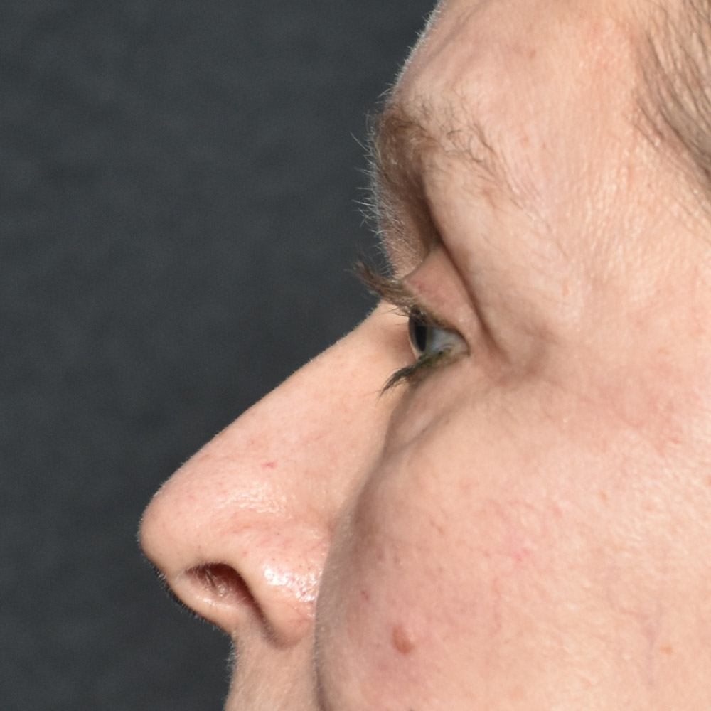 Case--7435 | After Brow Lift Surgery 2