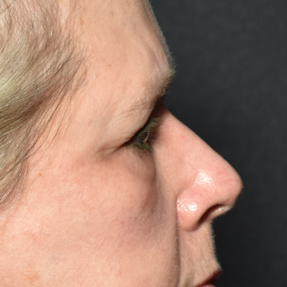 Case--7435 | Before Brow Lift Surgery 3