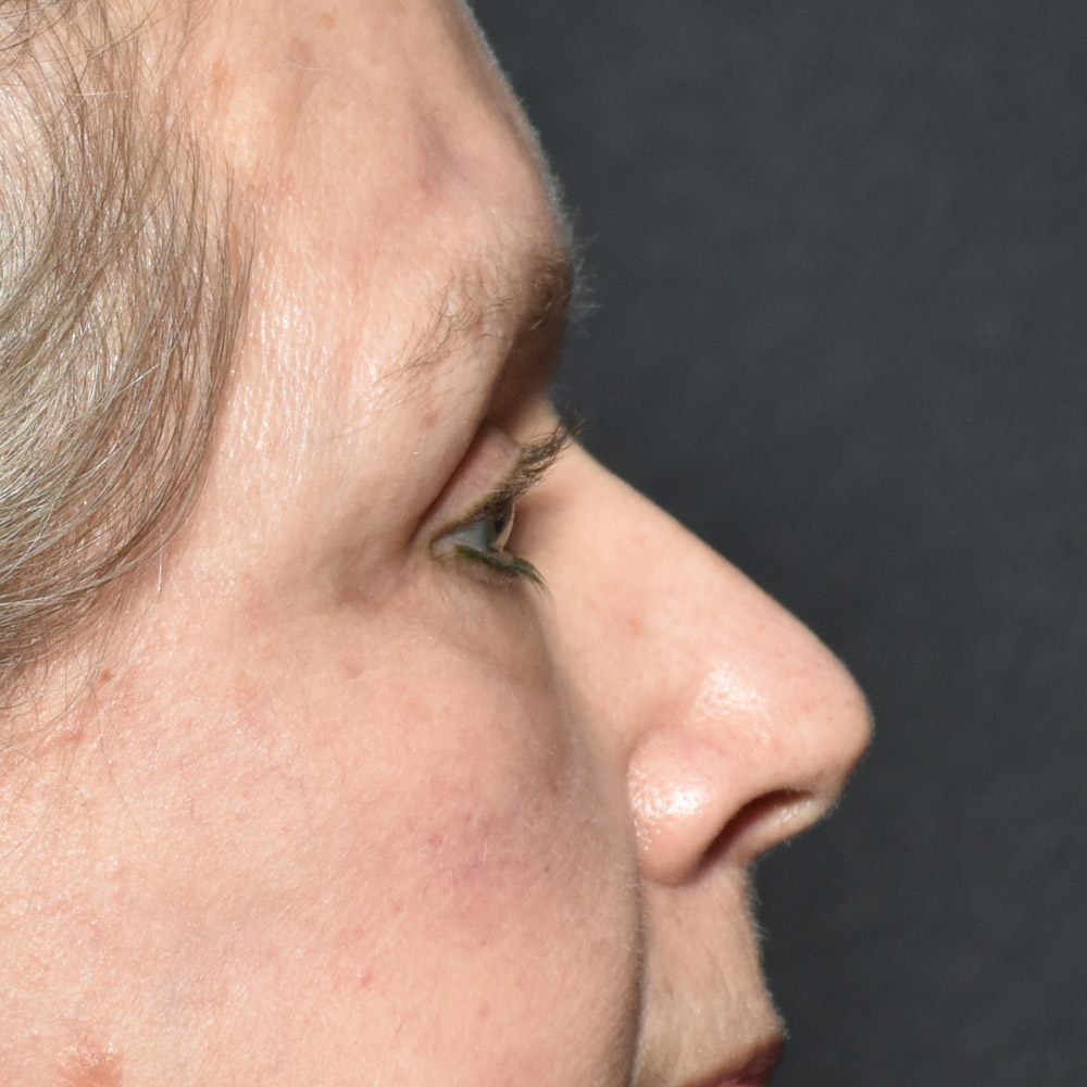 Case--7435 | After Brow Lift Surgery 3