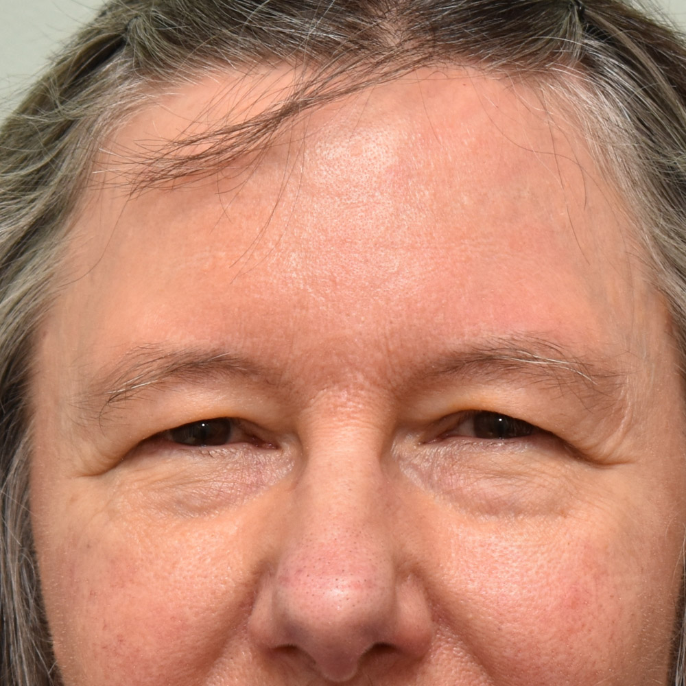 Case--9410 | Before Brow Lift Surgery