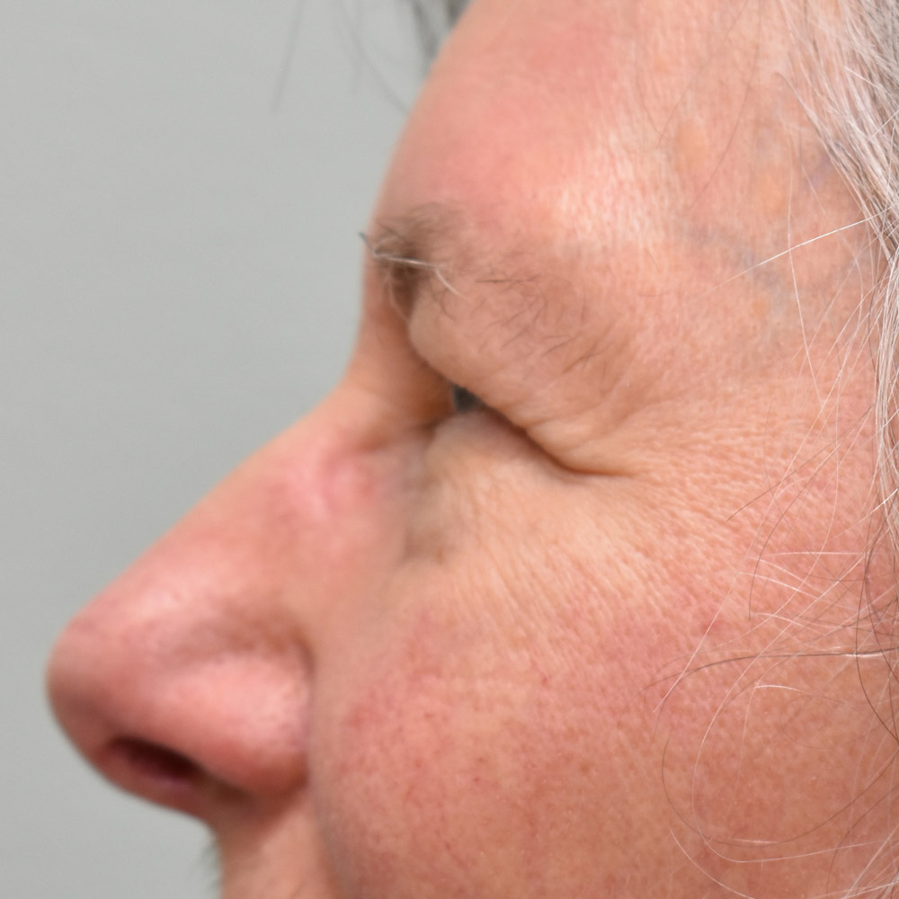 Case--9410 | Before Brow Lift Surgery 2