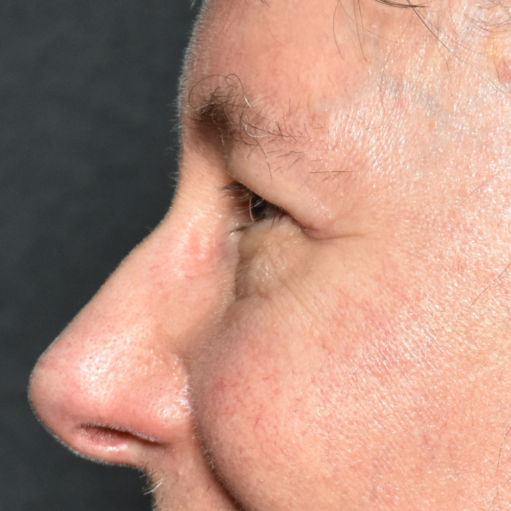 Case--9410 | After Brow Lift Surgery 2