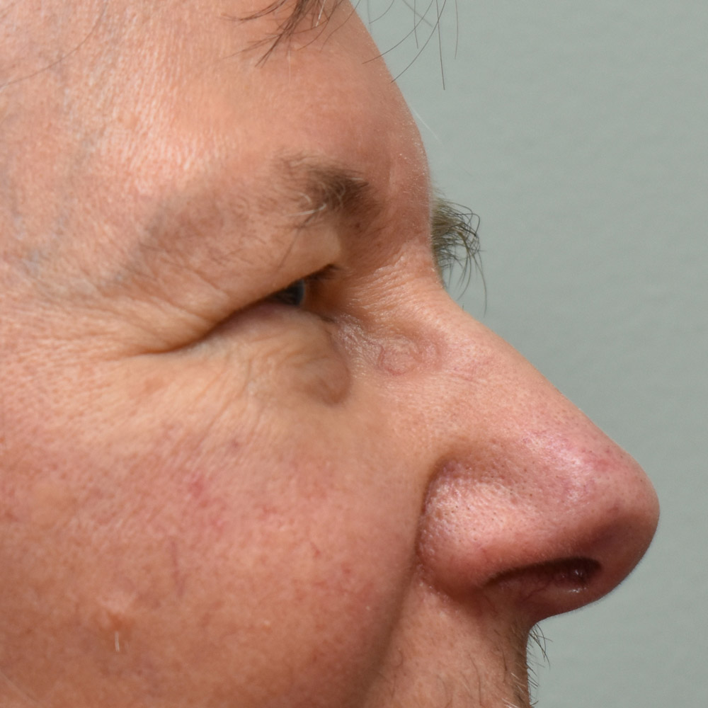 Case--9410 | Before Brow Lift Surgery 3