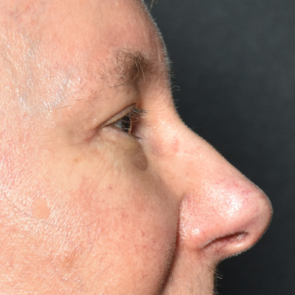 Case--9410 | After Brow Lift Surgery 3