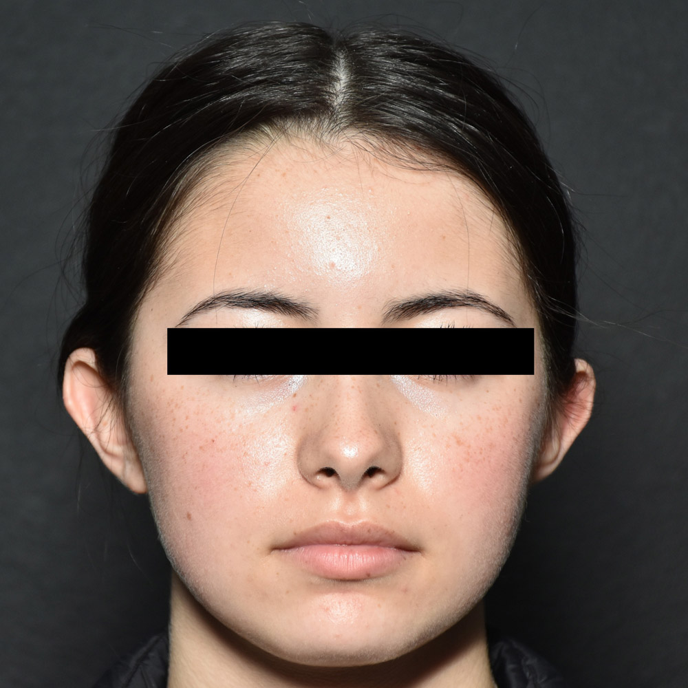 53532 Before Ear Pinning Surgery - Lake Oswego and Portland, Oregon