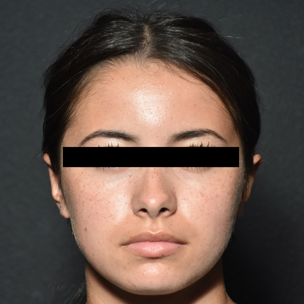 53532 After Ear Pinning Surgery - Lake Oswego and Portland, Oregon