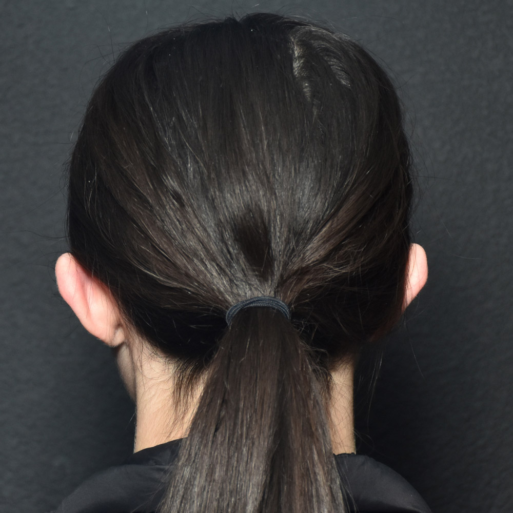 53532 After Ear Pinning Surgery - Lake Oswego and Portland, Oregon