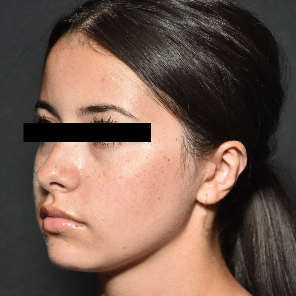 53532 Before Ear Pinning Surgery - Lake Oswego and Portland, Oregon