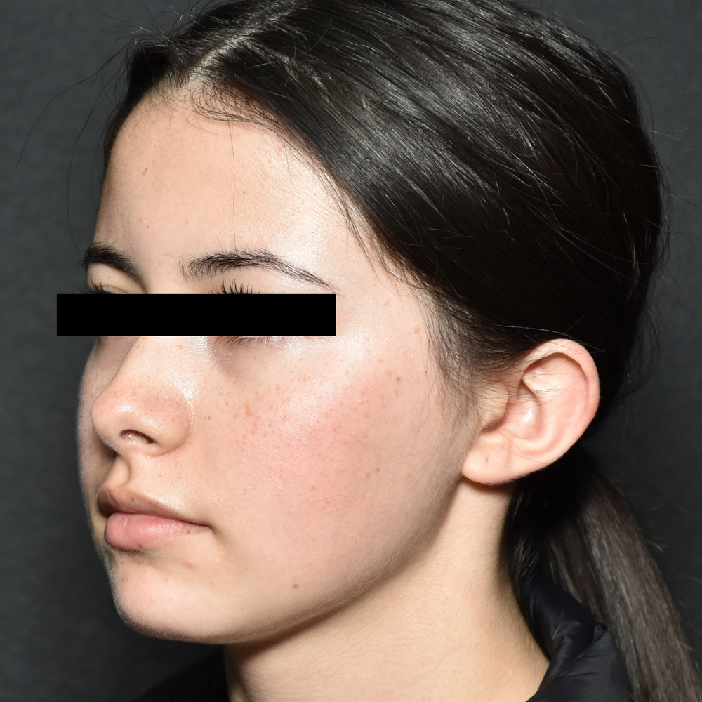 53532 After Ear Pinning Surgery - Lake Oswego and Portland, Oregon