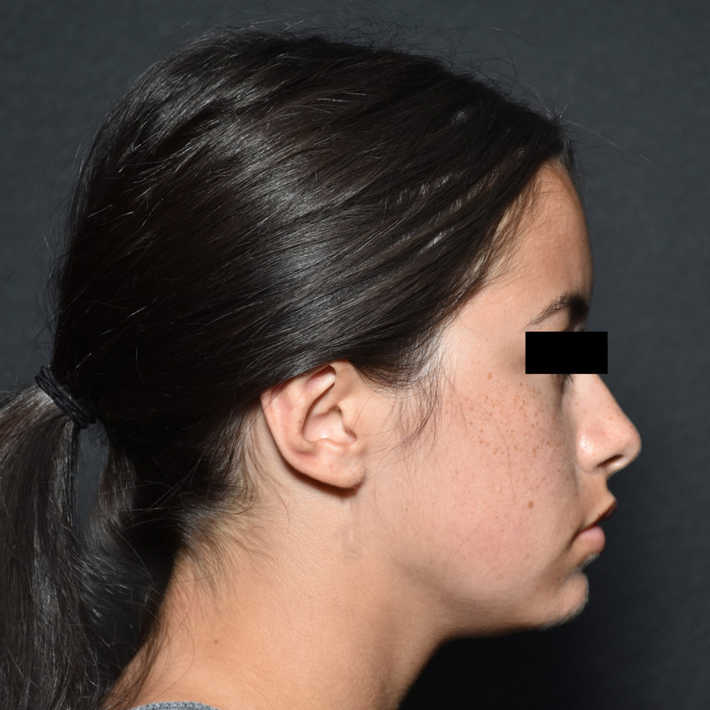 53532 Before Ear Pinning Surgery - Lake Oswego and Portland, Oregon