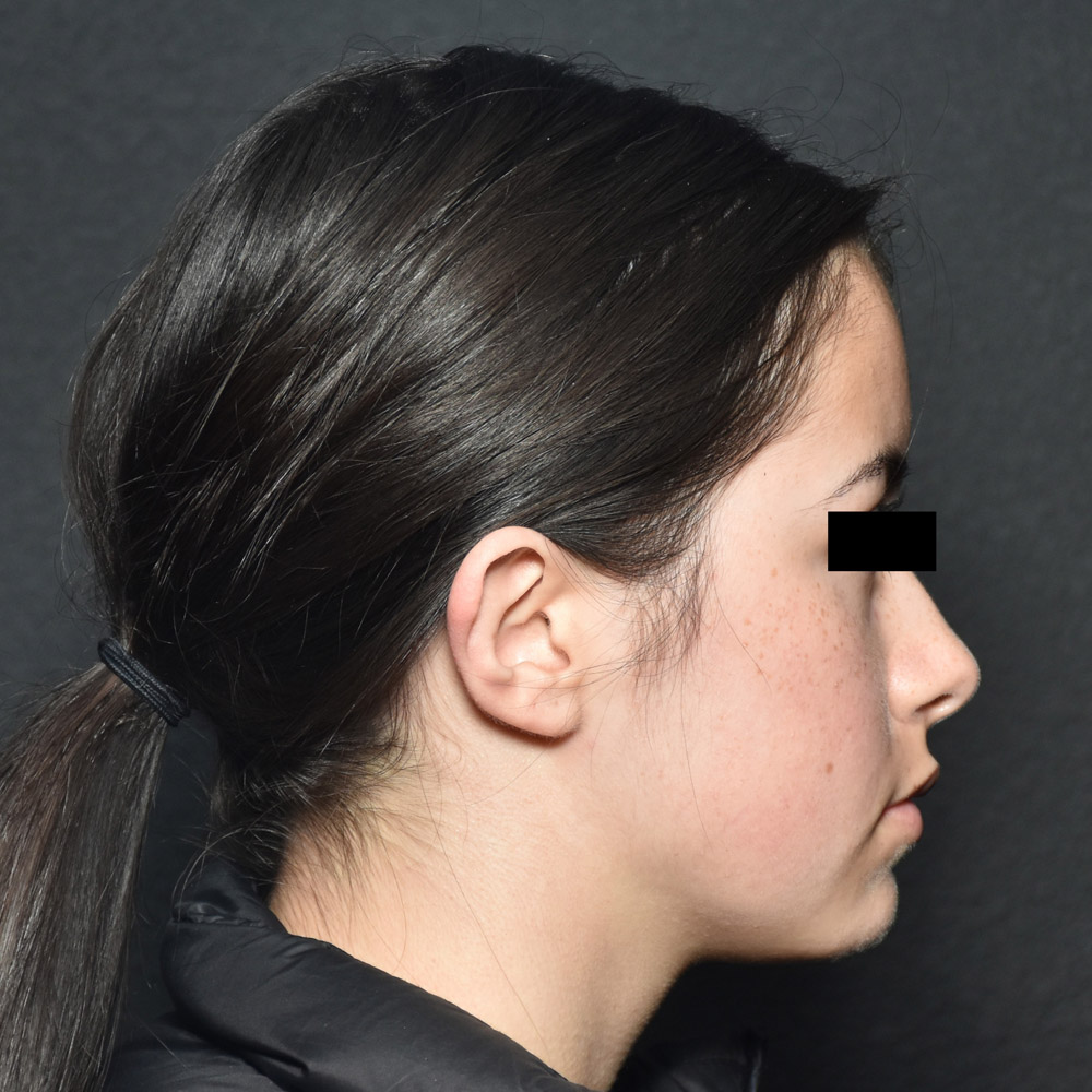 53532 After Ear Pinning Surgery - Lake Oswego and Portland, Oregon