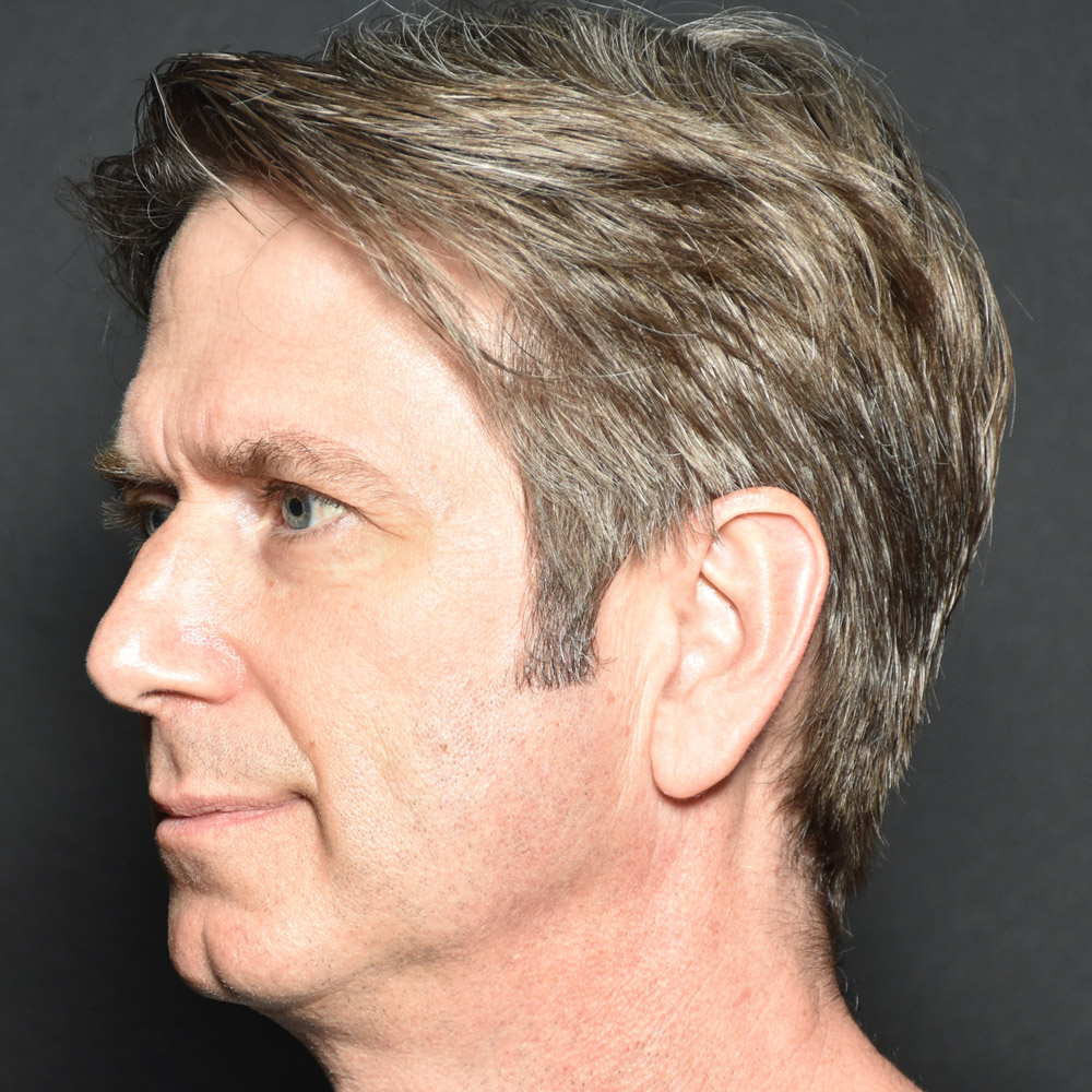 53532 After Earlobe Repair - Lake Oswego and Portland, Oregon