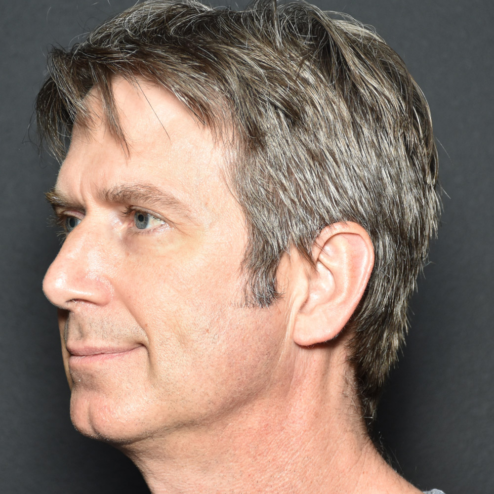 53532 Before Earlobe Repair - Lake Oswego and Portland, Oregon