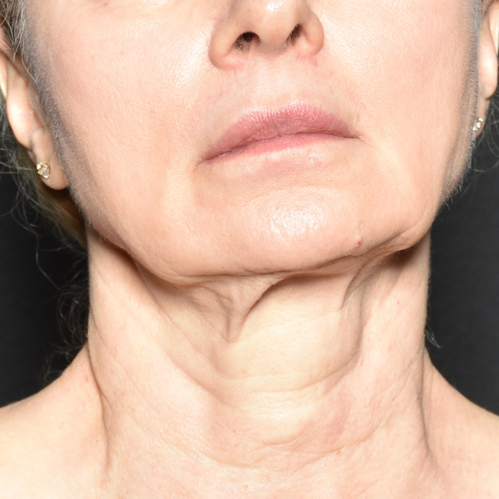 Case--3334 | Before Facelift and Neck Lift 2