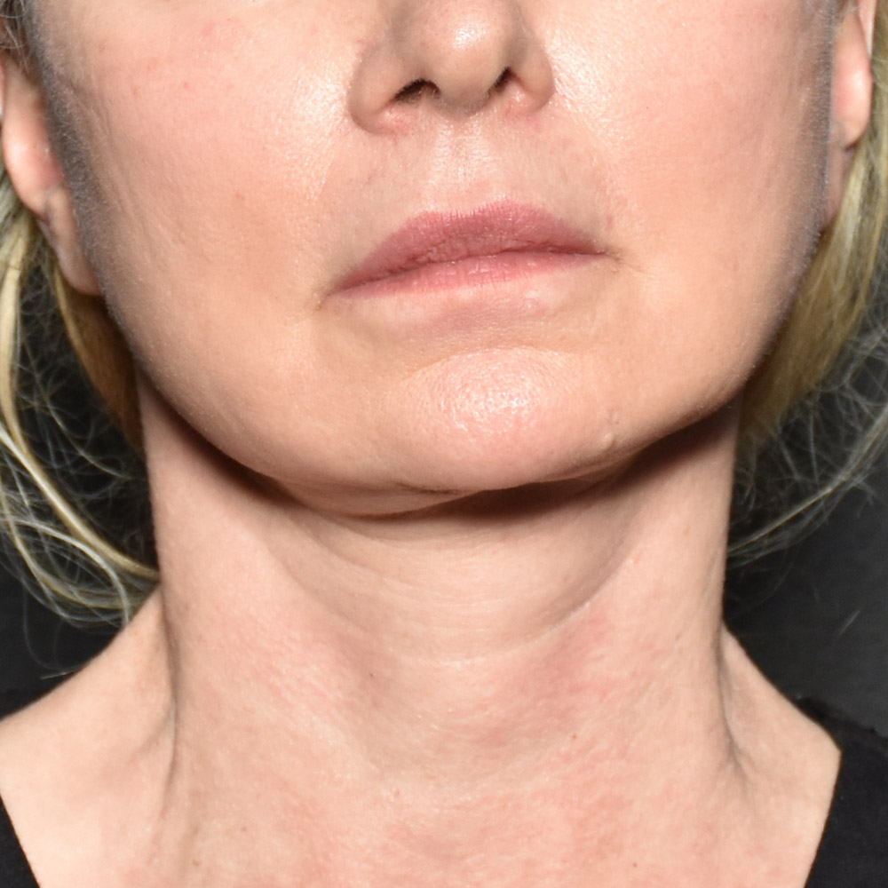 Case--3334 | After Facelift and Neck Lift 2