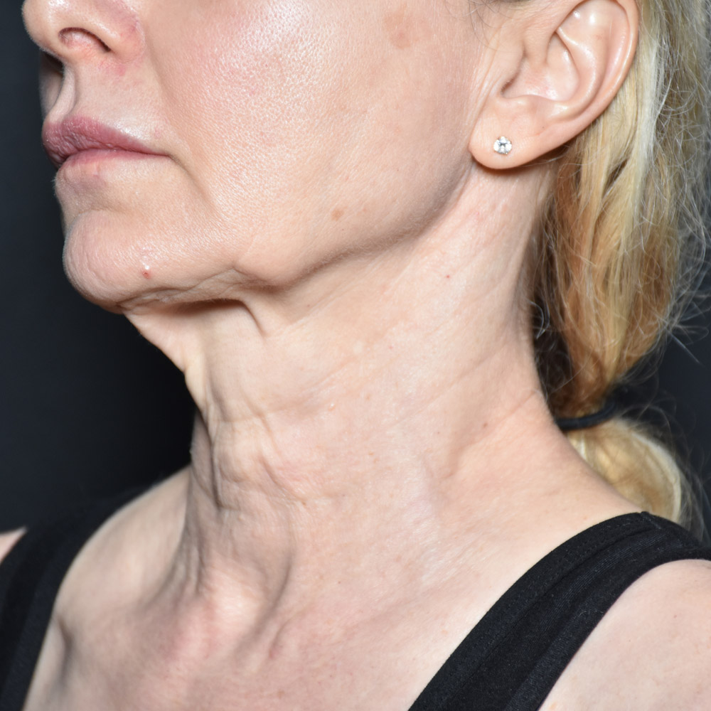 Case--3334 | Before Facelift and Neck Lift 3