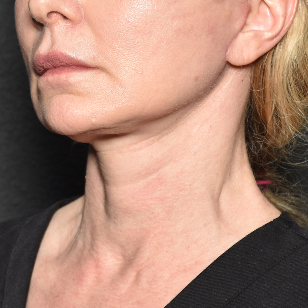 Case--3334 | After Facelift and Neck Lift 3